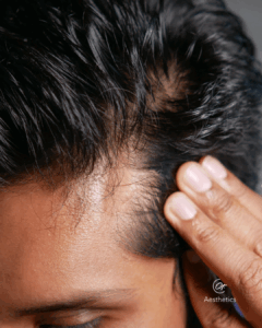 Behandlung Haarausfall Stuttgart