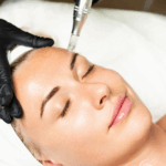 Microneedling