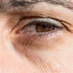 Tränenrinne Unterspritzen