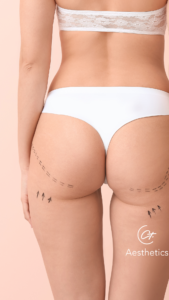 Sculptra Body